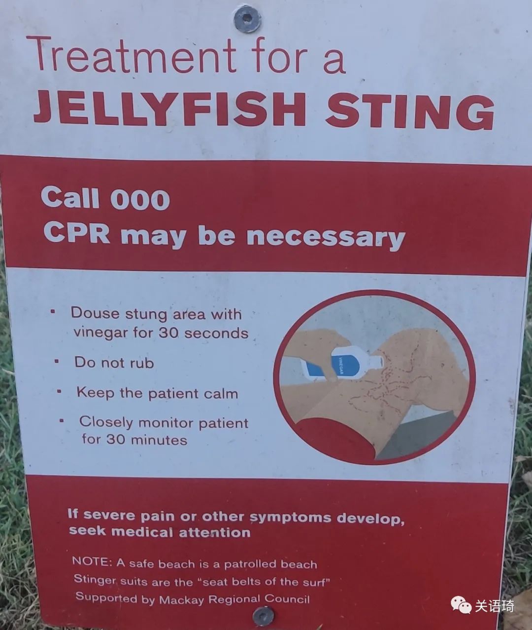 土澳海滩游泳前不看警示牌，惨遭水母咬伤！