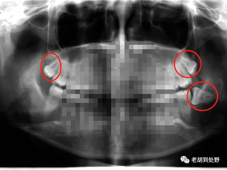在澳口腔手术经验分享：一次性拔三颗智齿